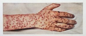 A hand with red and brown crusty lesions from smallpox