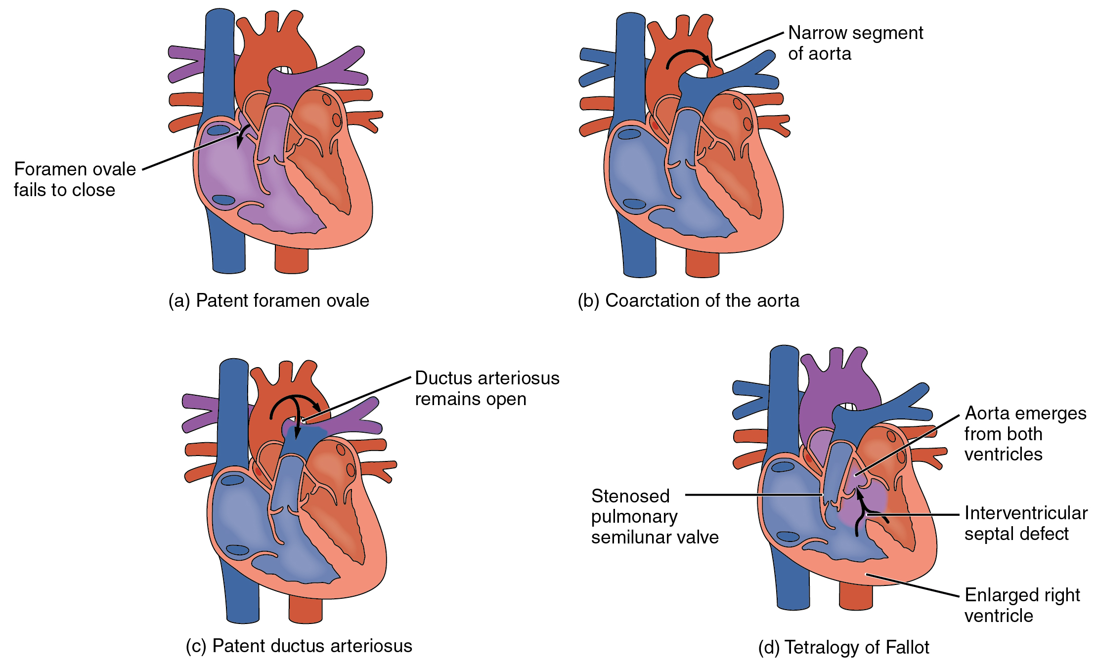 This diagram shows the structure of the heart with different congenital defects. The top left panel shows patent foramen ovale, the top right panel shows coarctation of the aorta, the bottom left panel shows patent ductus ateriosus and the bottom right shows tetralogy of fallot.