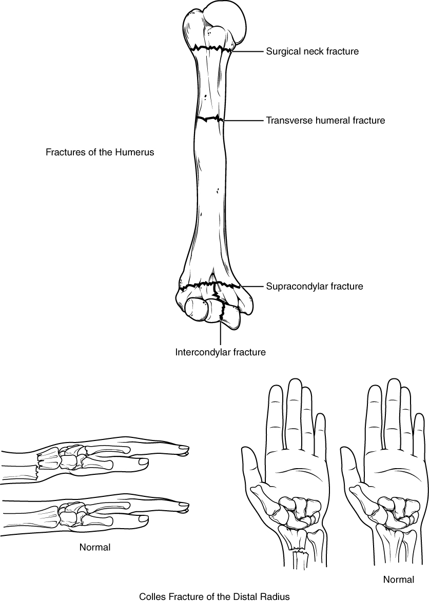 The top panel of this figure shows the different types of fracture in the humerus, and the bottom panel shows the different types of fracture in the radius.